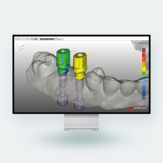 Magic Model 3D Implant | Implantatmodul f&uuml;r Dental CAD-Modelbuilder